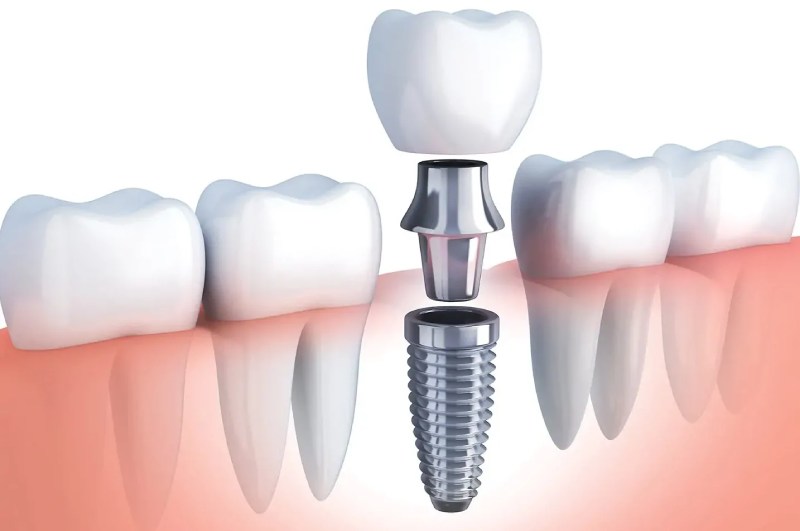 tandheelkundige implantaten